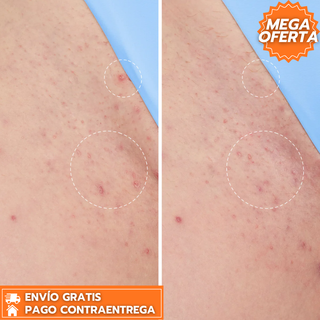 Peach Slices Roll-On™: Exfoliante que Previene Vellos Encarnados y Suaviza la Piel en Zonas Delicadas como Axilas, Piernas y Bikini.